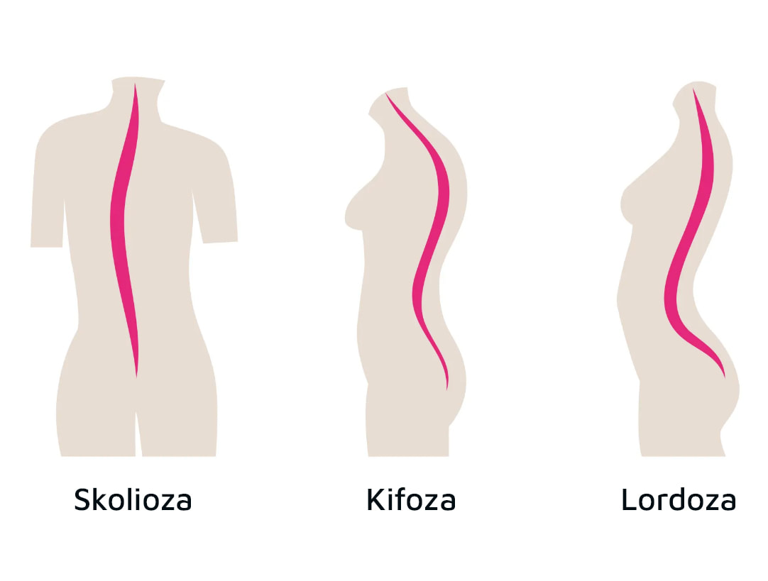 usporedba 3 deformacije kralježnice: skolioza, kifoza i lordoza