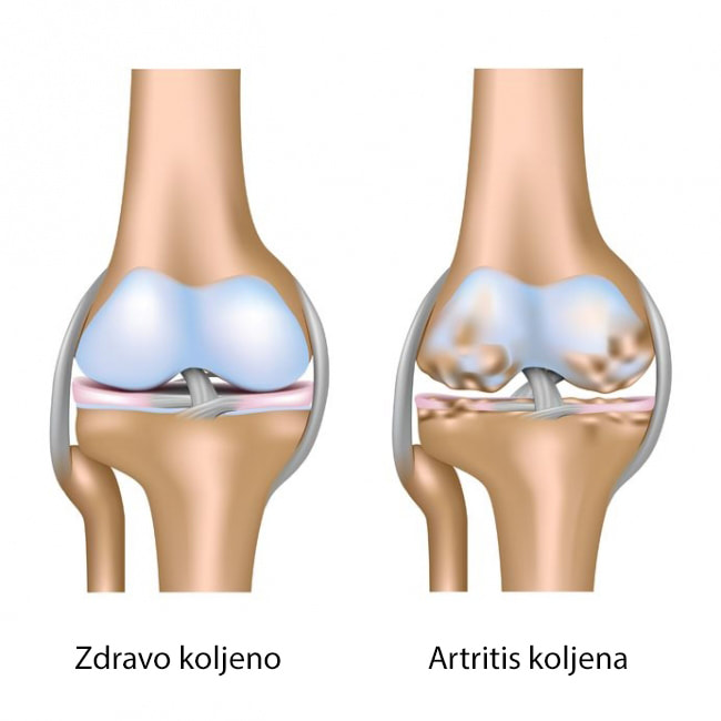 Usporedba zdravog koljena i koljena s artritisom. 