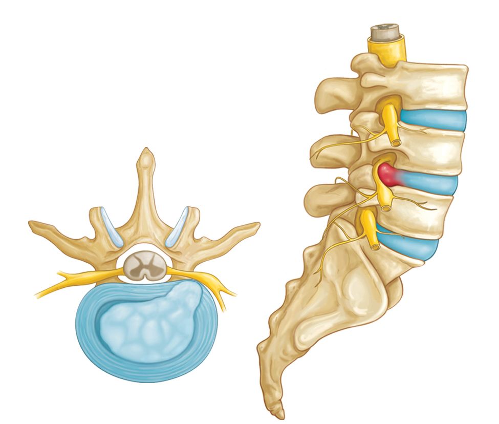 Grafički prikaz bulging diska i uklještenja spinalnog živca (radikulopatija).