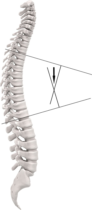 grafički prikaz kralježnice i dvije linije koje označavaju cobbov kut