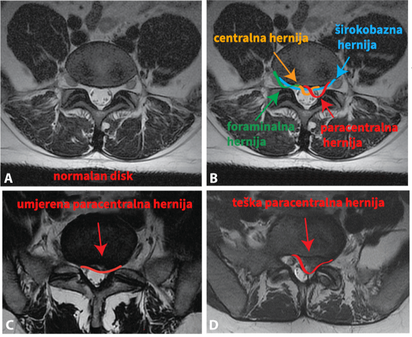 Snimke magnetske rezonance na kojima se vide centralna, paracentralna, foraminalna i širokobazna protruzija diska.