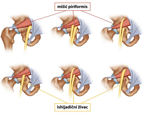 6 anatomskih varijacija odnosa mišića piriformisa i išijadičnog živca