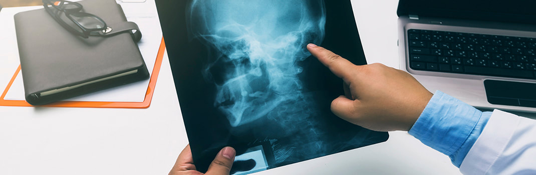 Ruka liječnika koja drži rendgen sliku glave i pokazuje na osteofit na lubanji. 
