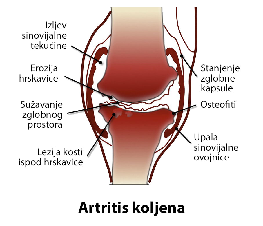 Koljeno zahvaćeno artritisom na kojem se vidi upala, istrošena hrskavica, otečenost i osteofiti