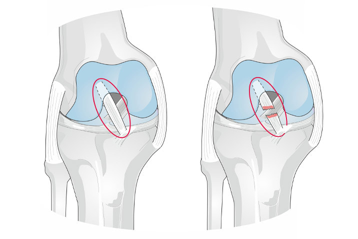 Usporedba zdravog koljena i koljena u kojem je puknut ligament.
