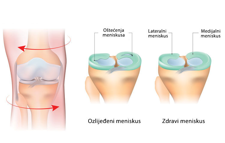 Prikaz rotacijske ozljede koljena te usporedba zdravog i oštećenog meniskusa koljena.