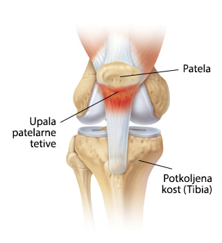 Prikaz koljenog zgloba i upale patelarne tetive. 