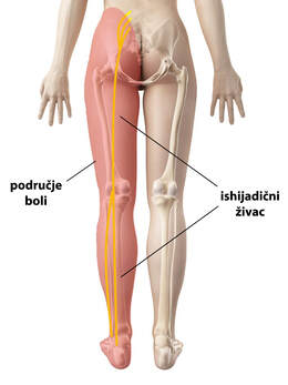 Anatomski prikaz ishijadičnog živca i područja koje zahvaća bol kod išijasa. 