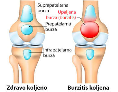 Usporedba zdravog koljena i koljena s upalom burzi u području patele. 