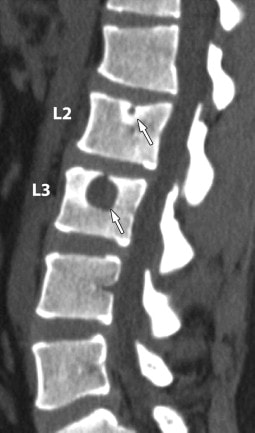 Snimka magnetske rezonance kralježnice na kojoj se vide mala i velika Schmorlova hernija