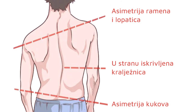 Mladi muškarac sa skoliozom koji ima asimetrična ramena, lopatice, iskrivljenju kralježnicu i asimetrične kukove.