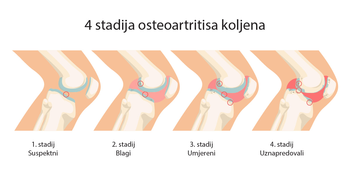 Prikaz četiri različita stupnja osteoartritisa koljena: suspektni, blagi, umjereni i uznapredovala artroza koljena. 
