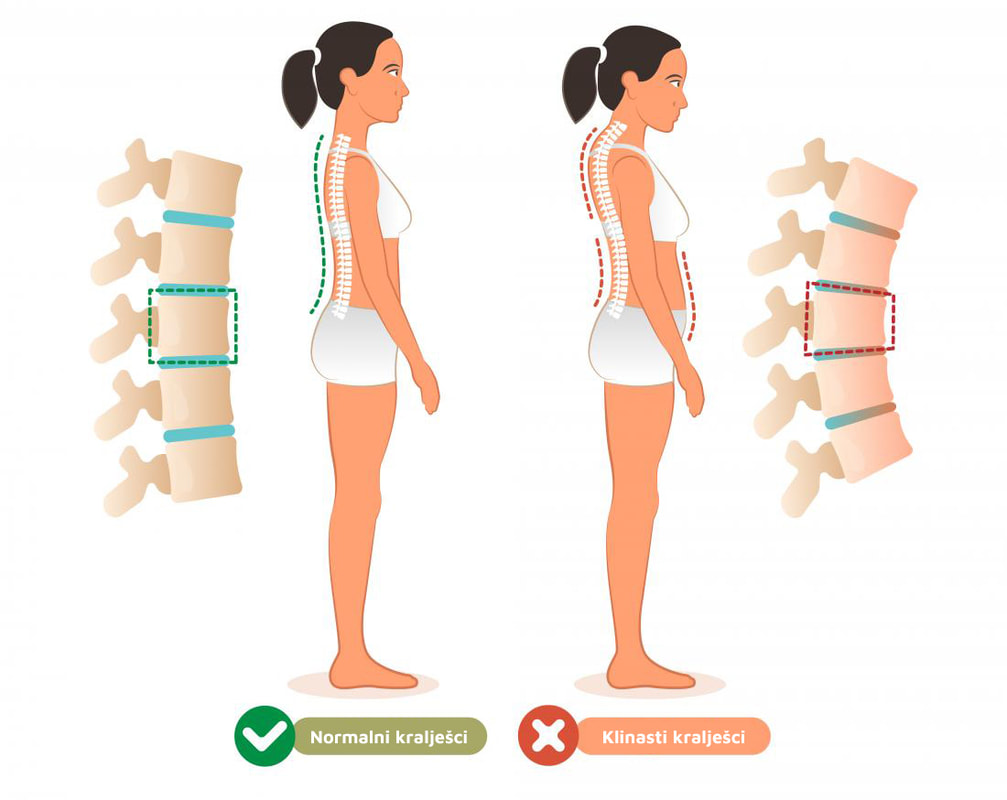 grafički prikaz usporedba zdravih kralježaka i kralježaka koji imaju oblik klinova